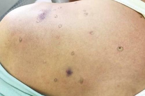 Người đàn ông bị sưng nề, suy thận do bị ong vò vẽ đốt hơn 40 nốt