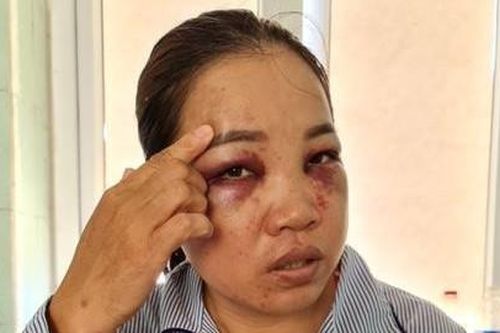 Người đàn bà bị chồng cũ tìm đến tận nhà đánh đập dã man
