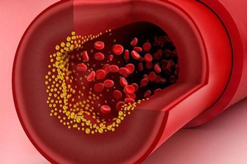 Cách loại bỏ cholesterol xấu gây hại cho sức khỏe