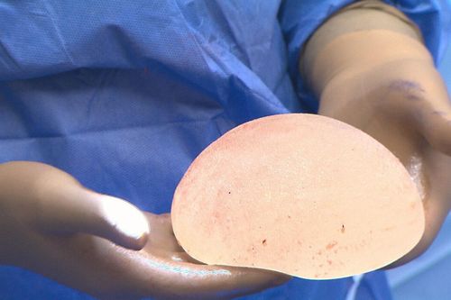 Người phụ nữ bị vỡ túi nâng ngực sau 6 năm phẫu thuật