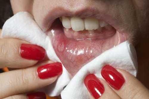 Thấy dấu hiệu này đừng nghĩ bị nhiệt tới bệnh viện ngay kẻo ung thư miệng giai đoạn cuối