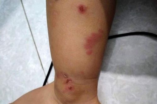 Thông tin cô giáo cắn trẻ mầm non không chính xác