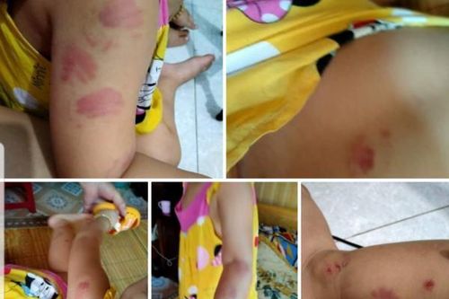 Thái Bình: Điều chuyển cô giáo mầm non để bé 21 tháng bị cắn tím người