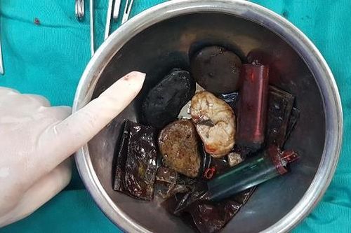 Cứu sống 'dị nhân' ăn đủ thứ, từ đá sỏi, bật lửa, túi nilon đến cả... dao lam