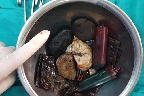 Hy hữu: Người đàn ông ăn được 'tất cả mọi thứ'