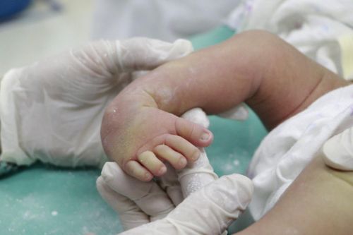 Phục hồi bàn chân cho bé trai bị khoèo bẩm sinh