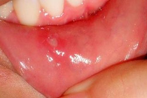 Ứng phó với tình trạng loét miệng