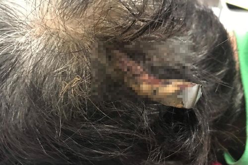 Người đàn ông bị thanh sắt đâm xuyên sọ khi ngã