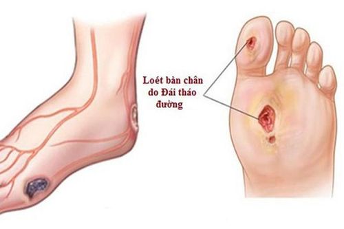 Kinh hoàng căn bệnh 'giết người thầm lặng', 30 giây lại có người bị cắt cụt chi