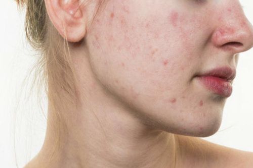 Tiêu diệt mụn bằng 11 loại mặt nạ 'tự chế'
