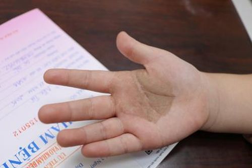 Cảnh báo bệnh nhiễm nấm đen ở trẻ em