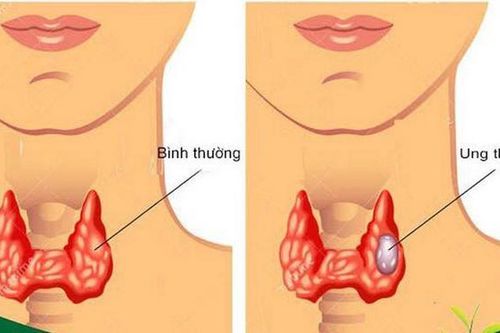 Ung thư tuyến giáp có thể chữa khỏi nếu phát hiện sớm, chữa trị đúng
