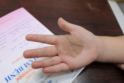 Tưởng con bị bớt sắc tố, đi khám mới biết nhiễm nấm đen