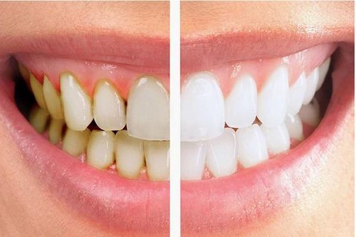 Điều gì xảy ra khi ngừng đánh răng?