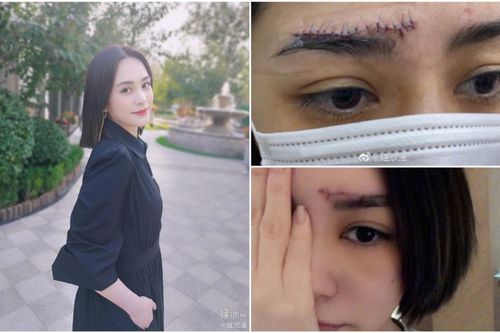 Chung Hân Đồng lần đầu đăng ảnh sau khi bị thương nặng, nhiều người không thương mà còn mắng chửi