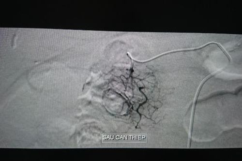 BV ĐKTW CT can thiệp nội mạch điều trị thành công cho bệnh nhân bị xuất huyết tiêu hóa nặng