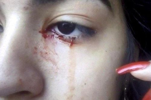 Bé gái 15 tuổi tại Brazil khóc ra máu khiến các bác sĩ đau đầu tìm nguyên nhân