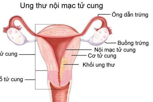 Niêm mạc tử cung dày bất thường không điều trị, 3 năm sau bị ung thư nội mạc tử cung