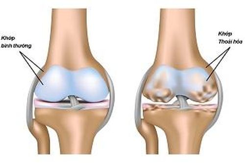 Canakinumab có thể làm chậm quá trình thoái hóa khớp?
