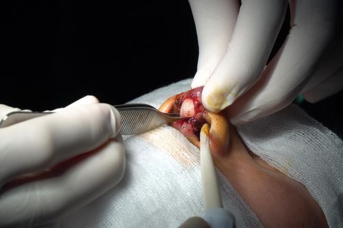 Một phụ nữ bị đứt lìa trụ mũi vì thẩm mỹ 'dạo'