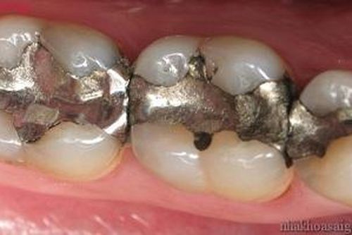 Cảnh báo rủi ro khi dùng chất trám răng chứa thủy ngân ở một số người