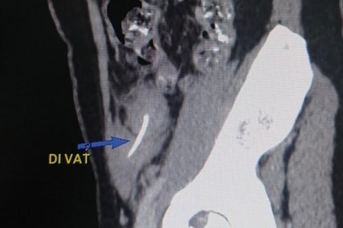 Thủng ruột vì hóc xương cá