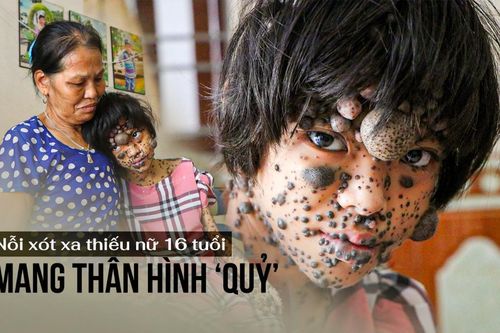 Nỗi xót xa thiếu nữ 16 tuổi mang thân hình 'quỷ', sống u sầu bởi ai nhìn cũng khiếp sợ