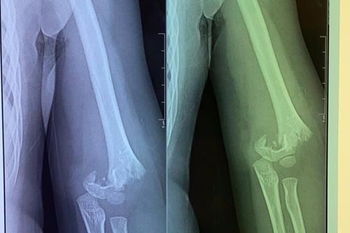 Sở GD&ĐT Hà Nội yêu cầu xác minh làm rõ vụ bé gái 5 tuổi ở gãy lìa xương khuỷu tay ở trường mầm non