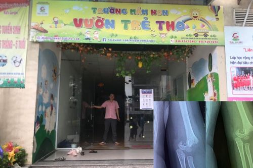 Mẹ bé gái 5 tuổi bị gãy lìa xương khuỷu tay ở trường mầm non: 'Con tôi đang hoảng loạn vô cùng'