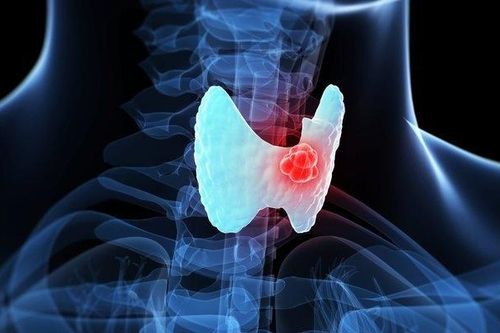 Những điều cần biết về khám tầm soát ung thư tuyến giáp tại Bệnh viện K
