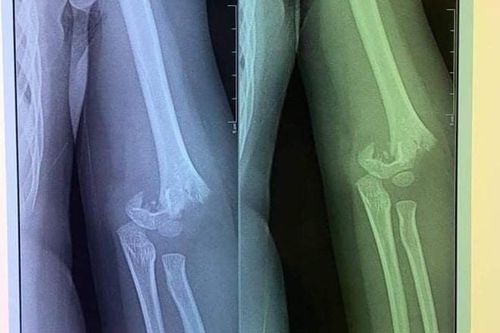 Bé 5 tuổi ở Hà Nội ngã gãy tay: Nhà trường lên tiếng