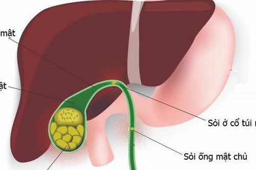 Nhận diện và xử trí kịp thời sỏi túi mật