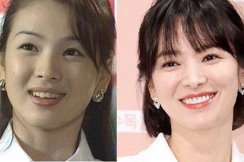 Cựu thần tượng Kpop tiết lộ quá trình làm răng của sao Hàn