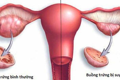 3 tháng không có kinh, cô gái độc thân đi khám tá hỏa phát hiện buồng trứng lão hóa như người người 50