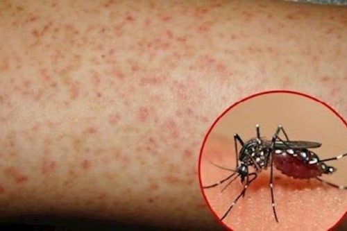 Khám phá mối liên quan giữa sốt xuất huyết và COVID-19