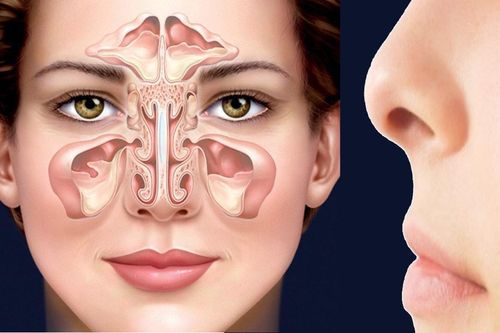 Bệnh viêm xoang có chữa được không?