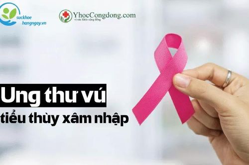 Ung thư vú tiểu thùy xâm nhập: Nguyên nhân, triệu chứng, chẩn đoán và phương pháp điều trị
