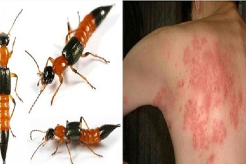 Hà Nội: Mỗi ngày có hàng trăm người đi khám do kiến ba khoang
