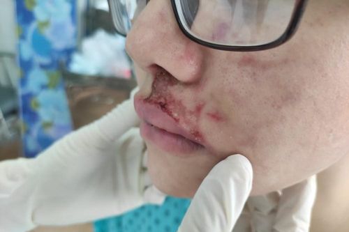 TPHCM: Cô gái trẻ sưng phù mặt khi tiêm filler làm đẹp