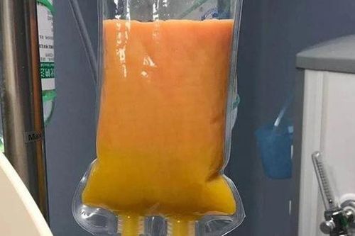 Ăn gà rán, 2 ngày sau sản phụ bị đau bụng, bác sĩ phải lọc huyết tương để cứu, các tạp chất lọc ra vàng như mỡ