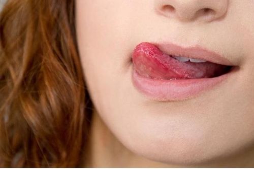 Khắc phục chứng môi luôn nứt nẻ