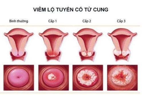 Một số tổn thương lành tính cổ tử cung