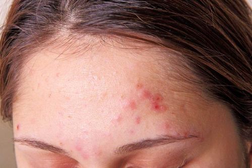 6 thói quen làm hại da nhạy cảm