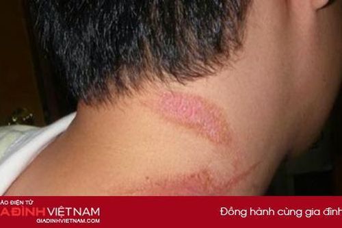 Hà Nội ghi nhận hàng nghìn trường hợp nhiễm độc kiến ba khoang phải vào viện