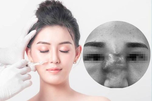 Mắc phải những sai lầm tai hại này khi tiêm filler, chị em có thể phá hủy cả gương mặt