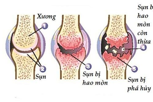 Bệnh thoái hóa khớp đang có xu hướng trẻ hóa