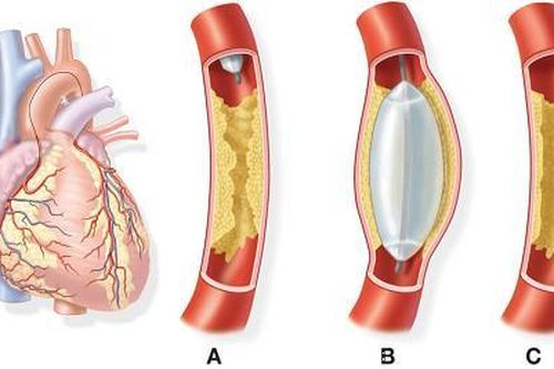 Bệnh tim mạch - kẻ giết người thầm lặng
