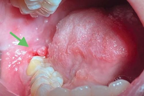 Người xưa có gặp biến chứng với răng khôn?