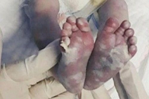 Những bệnh tình dục có thể lây truyền từ mẹ sang thai nhi