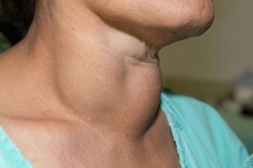Người phụ nữ được phát hiện mắc ung thư sau khi thấy nuốt khó